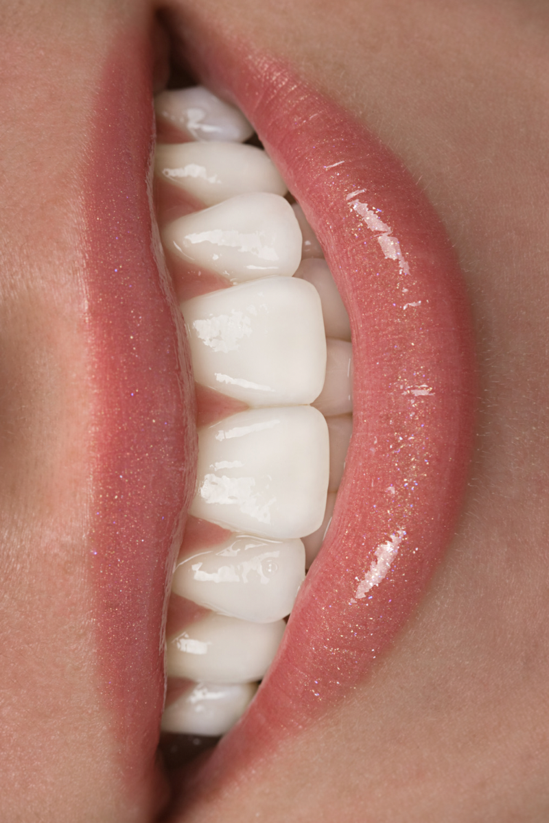 Blanqueamiento dental